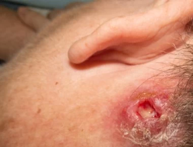 Σταφυλόκοκκος: Συμπτώματα, αίτια, θεραπεία και πρόληψη